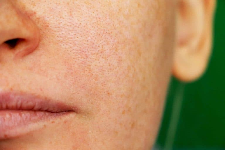 Excess Oil Skin Condition