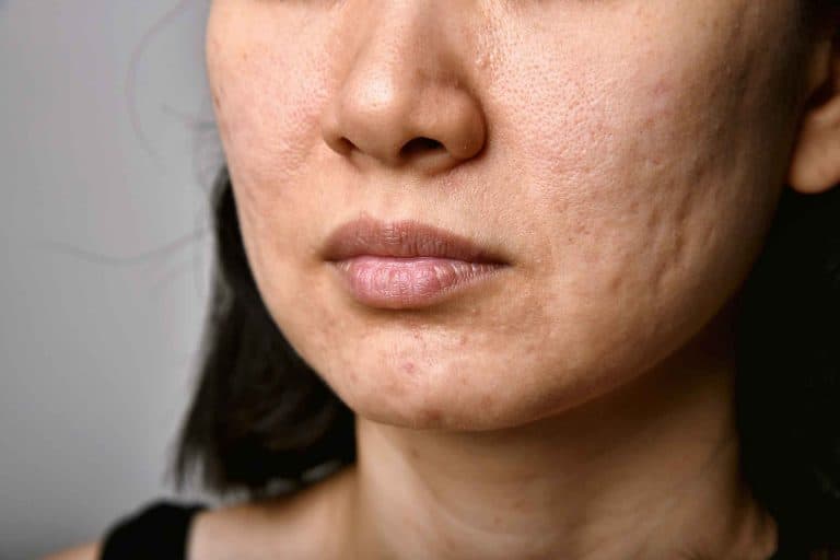 Acne Scarring Skin Condition Treatments