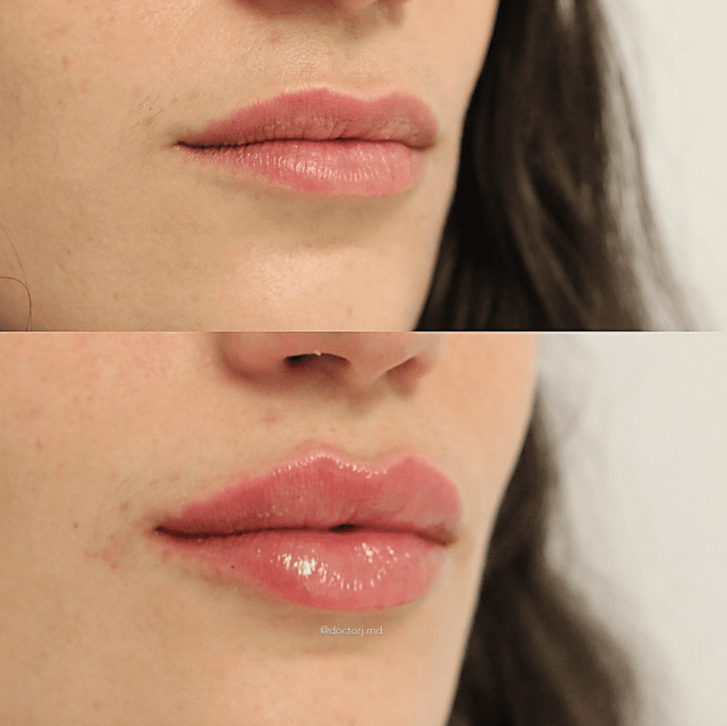 Dermal Fillers Lip Enhancement