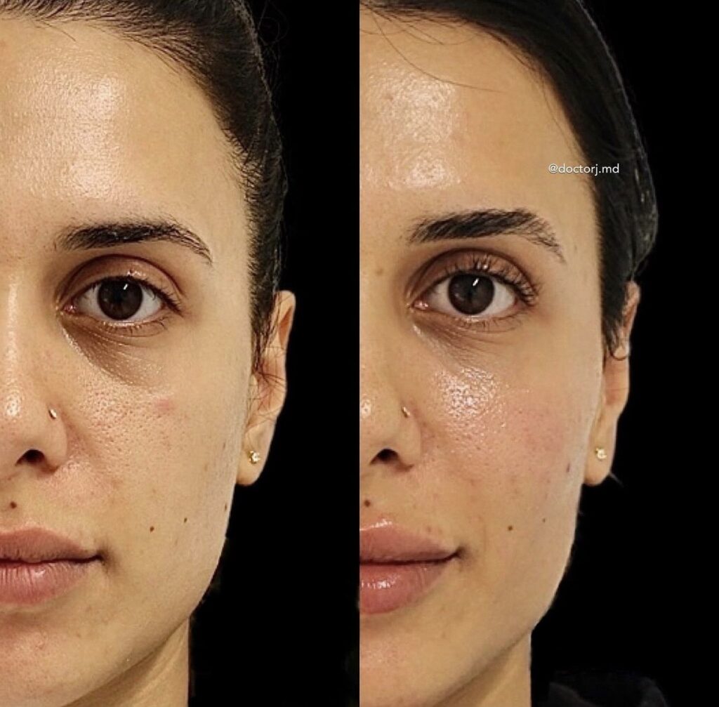 Tear Trough Eye Enhancement