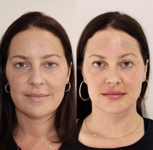 Upper-mid Face Enhancement