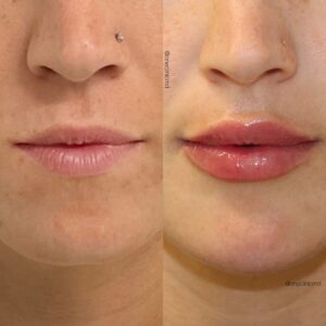 Lip Enhancement