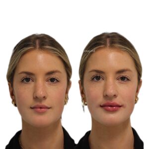 Lip Enhancement