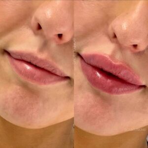 Lip Enhancement