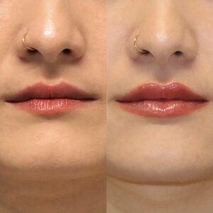 Lip Enhancement