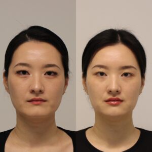 Tear Trough Eye Enhancement